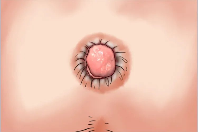 内痔肛门症状图片