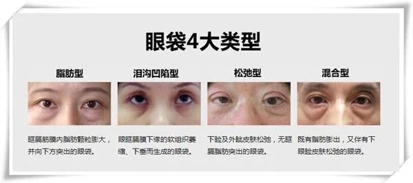 吸脂法去眼袋的优势和后遗症