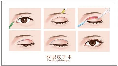 割双眼皮哪里好
