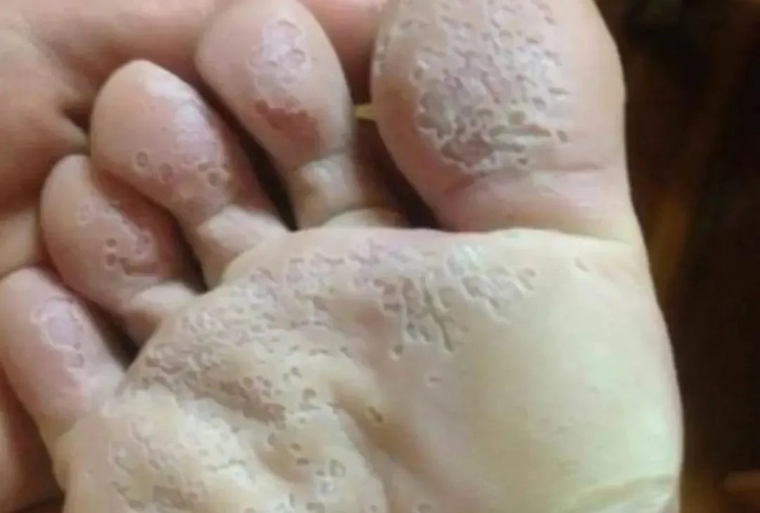 脚底板发白恶臭照片