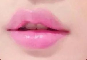 玻尿酸丰唇整形手术多少钱