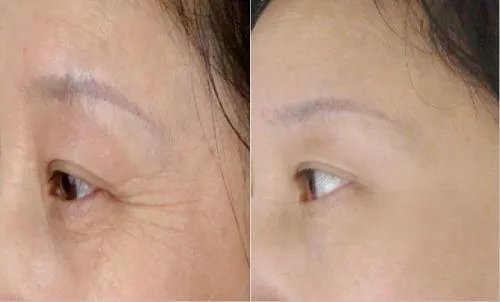 注射botox要多少费用多少钱