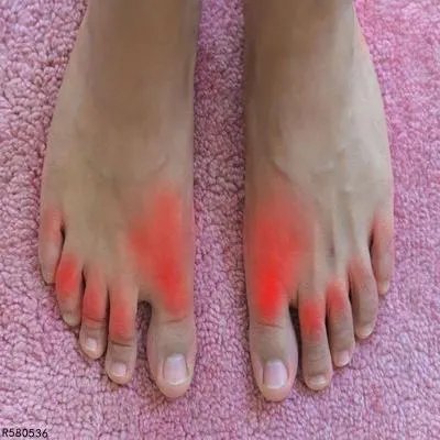 大母脚趾痛风的症状表现有哪些