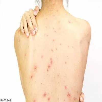 前胸后背长痘痘是什么原因 前胸后背长痘痘的主因分析