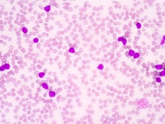 单核细胞综合症的治疗手段