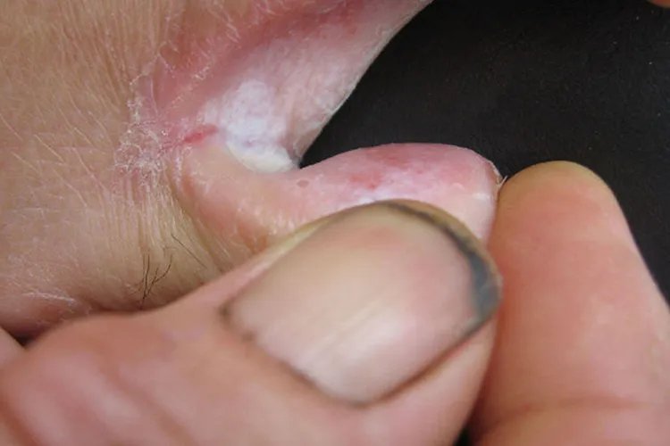 癣的种类与辨别图片