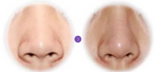 鼻孔整形术价格