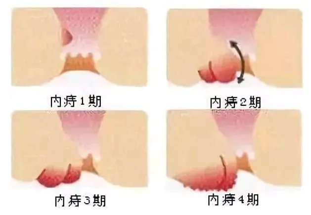 关于痔疮的一些常识