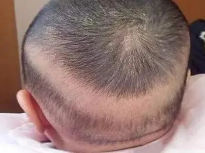 新生儿佝偻病症状图片