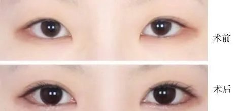 开内眼角后遗症该如何避免