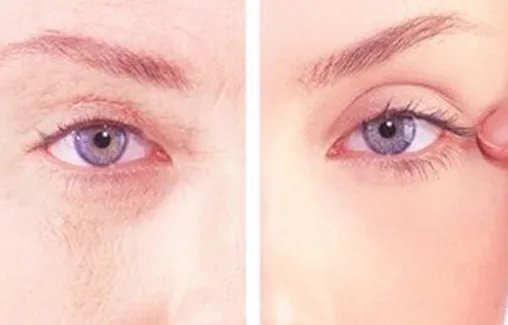 自体脂肪可以除皱吗	