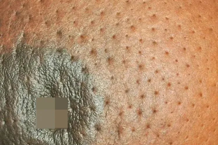 乳腺癌的症状图片