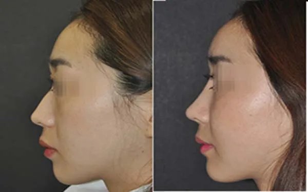 成都膨体隆鼻医院哪家好