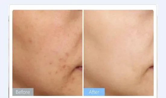 激光美白的效果怎么样?