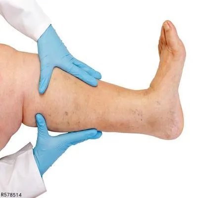 孕妇下肢水肿怎么办 孕妇下肢水肿的三方法介绍