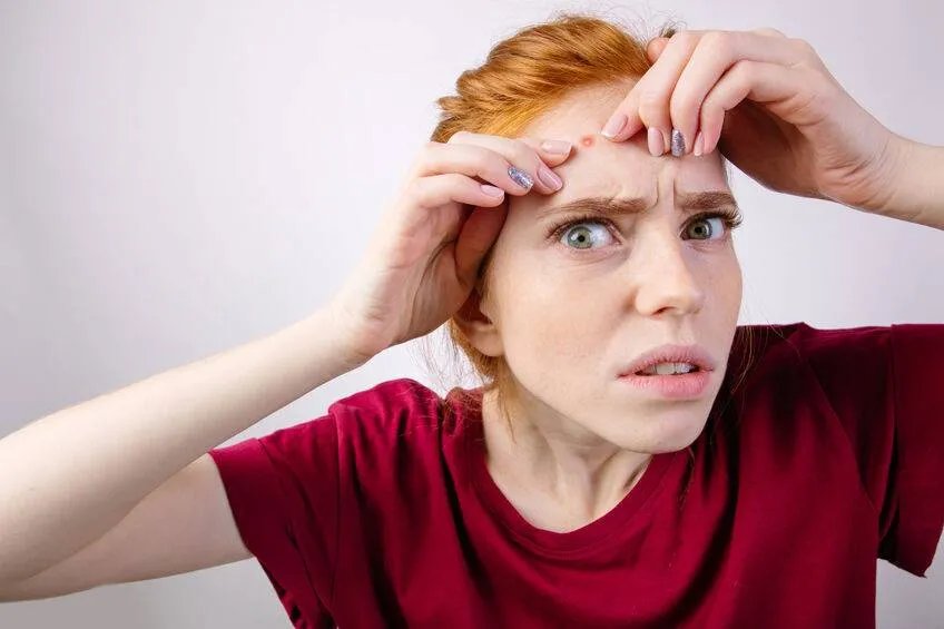 如何去除痤疮疤