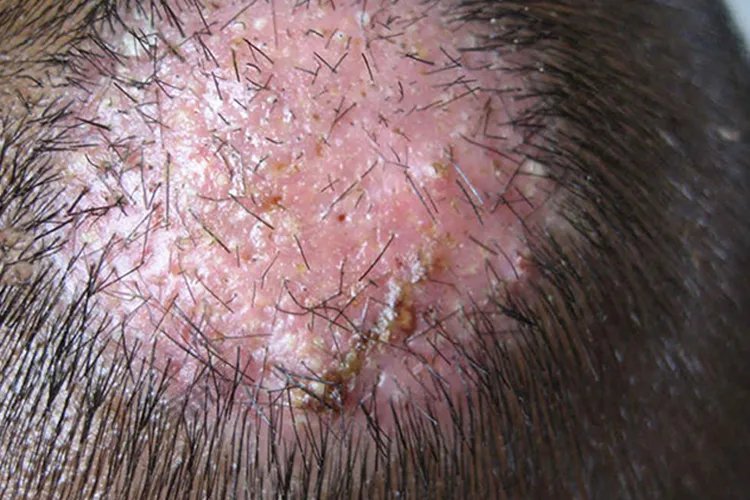 癣的种类与辨别图片