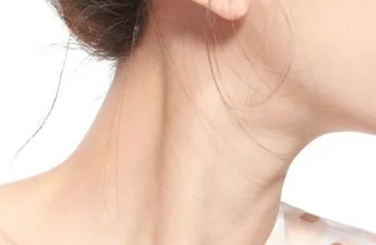 去除颈纹多少钱