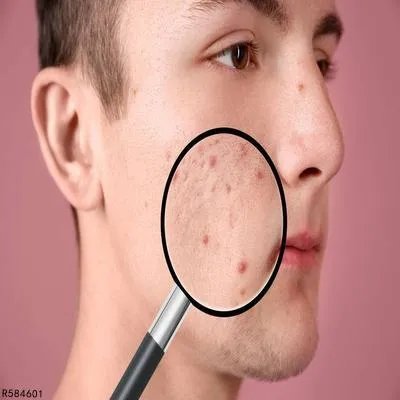 如何去黑头最有效