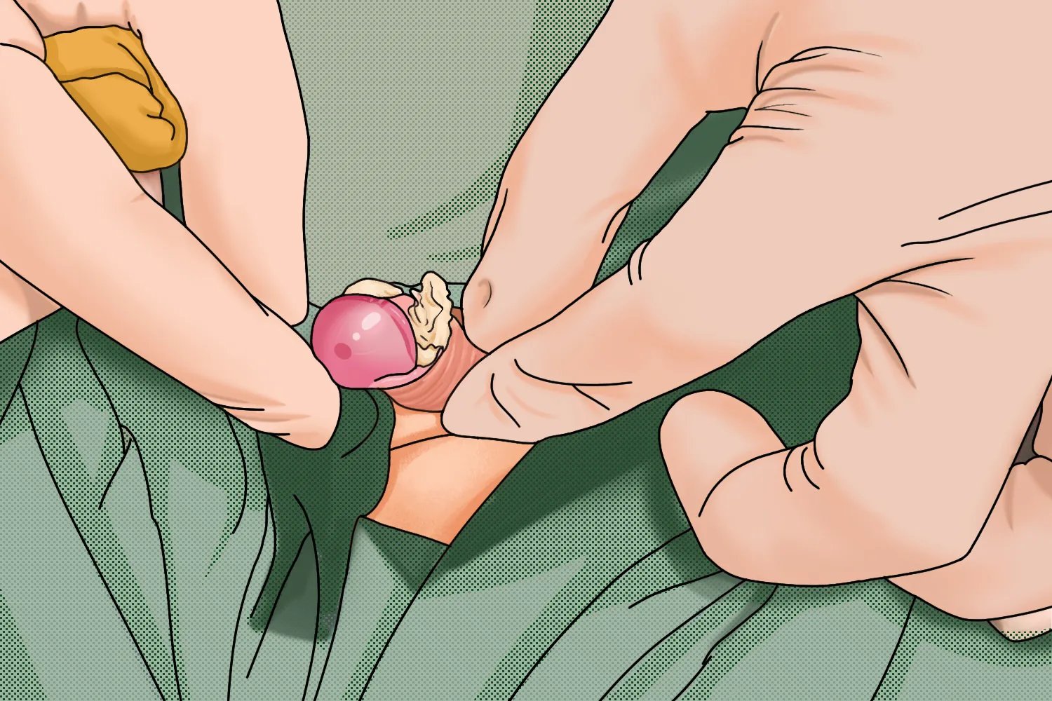 包茎的症状图片