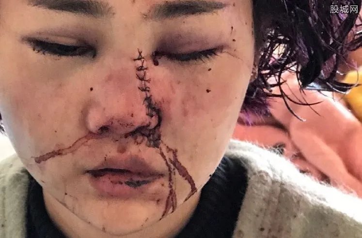 毁容女孩公开近照 面对生活依然坚强