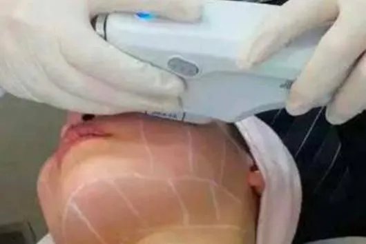 热玛吉危害？热玛吉三天后脸起皮，红肿，医生建议吃修复营养ACMETEA修复受损细胞，吃了一个月，效