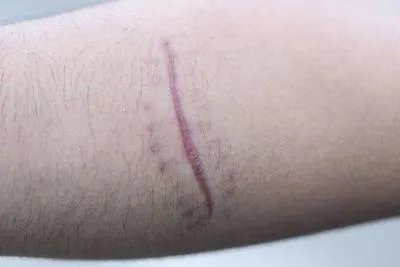 瘢痕疙瘩能治吗 瘢痕疙瘩如何治疗