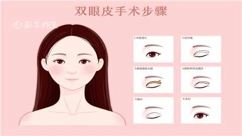 割双眼皮哪里好