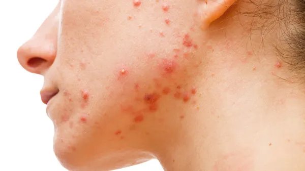 痤疮疤痕怎么去除