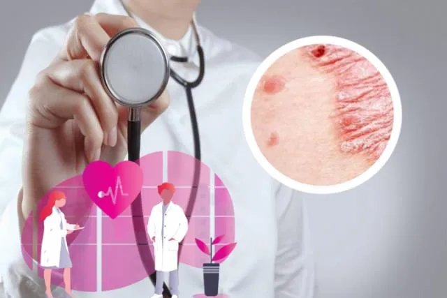 牛皮癣有偏方大全