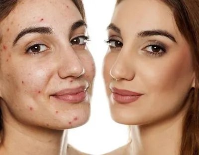 背上痘印如何消除