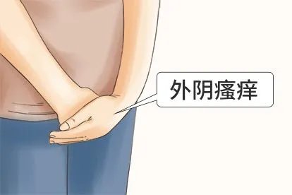 霉菌性阴炎的主要症状图片