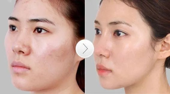 朝天鼻手术价格