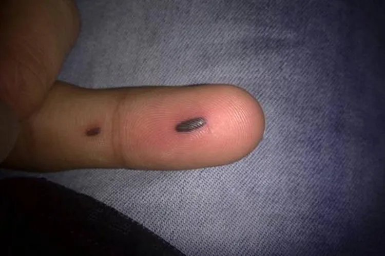 手指上黑点是癌症信号图片