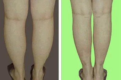 小腿吸脂效果怎样