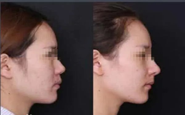 九院假体隆鼻多少钱