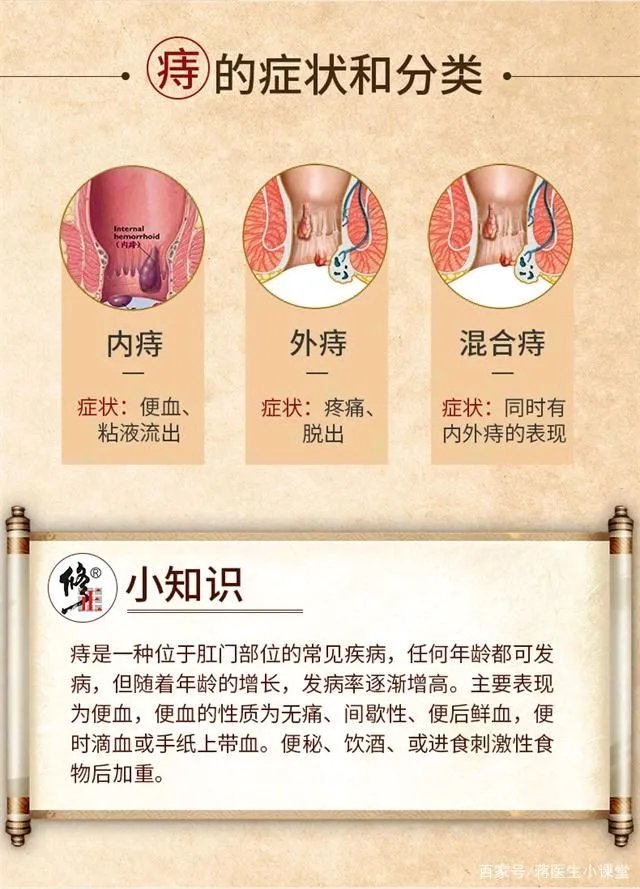 关于痔疮的一些常识