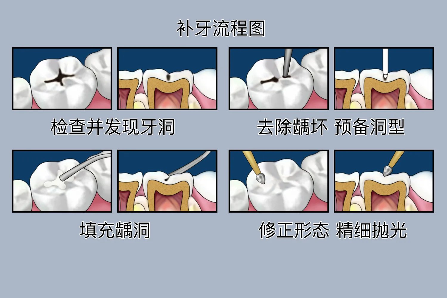 树脂补牙过程图解