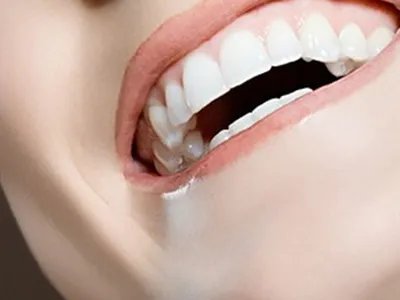 深圳烤瓷牙多少钱