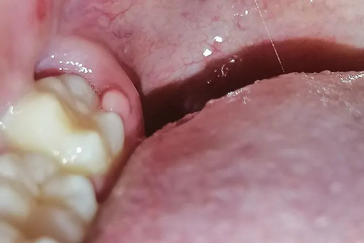 后槽牙后面的肉发白溃烂图片