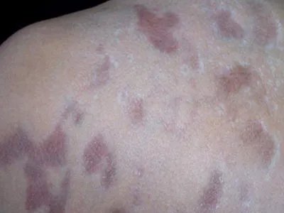 Pasini-Pierni进行性特发性皮肤萎缩红斑图片