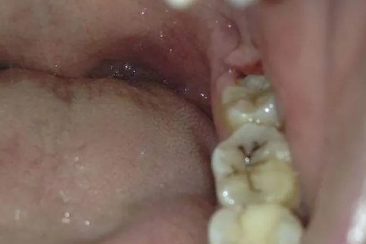 后槽牙后面的肉发白溃烂图片