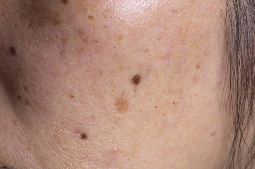 祛斑的方法有哪些