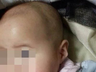 新生儿佝偻病症状图片