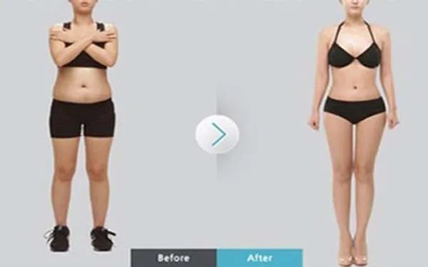 杭州吸脂减肥费用