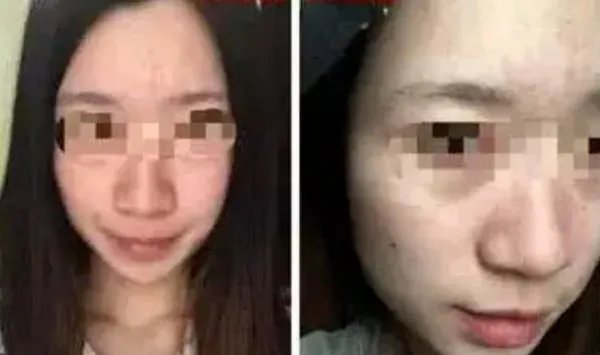 热玛吉危害？热玛吉三天后脸起皮，红肿，医生建议吃修复营养ACMETEA修复受损细胞，吃了一个月，效