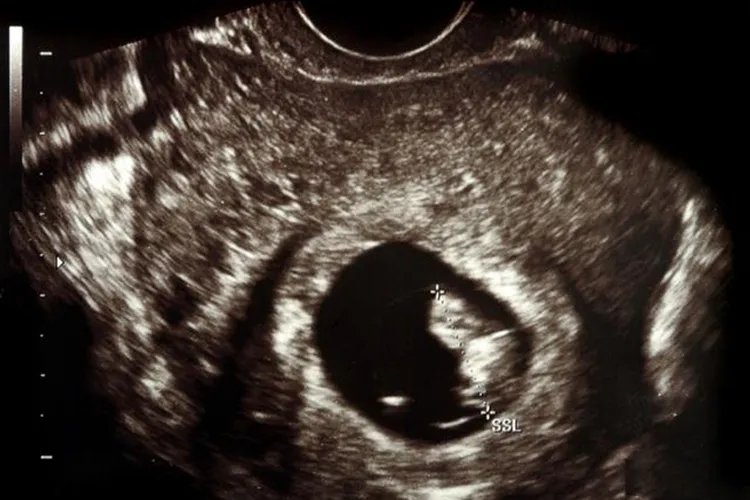 怀孕一个多月B超图片