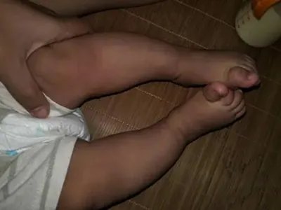 新生儿佝偻病症状图片