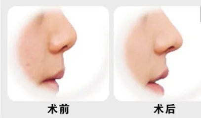 硅胶隆鼻前后对比