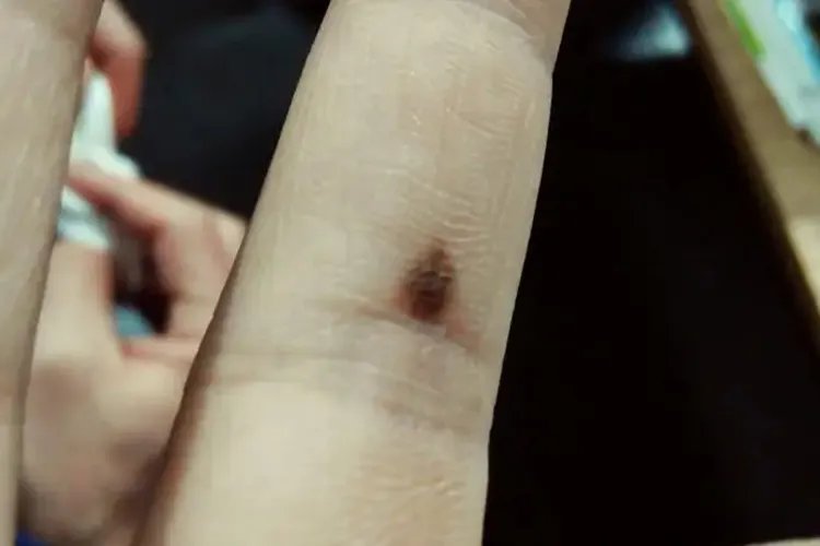 手指上黑点是癌症信号图片